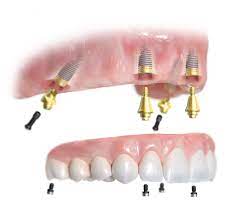 Single And All-on-4 Dental Implants - Ayar Dental, Ramsgate,NSW